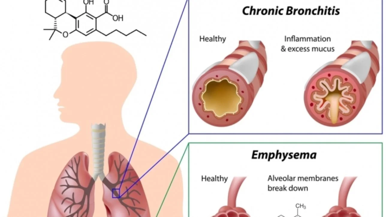 El Diagnóstico y Tratamiento de la Enfermedad Pulmonar Obstructiva Crónica en Medicina Interna